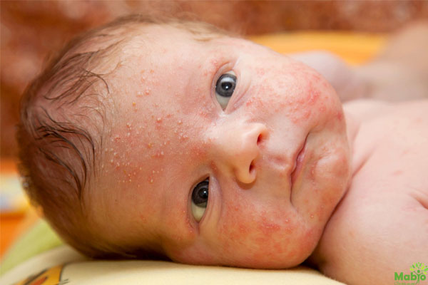 các bệnh về da thường gặp ở trẻ sơ sinh