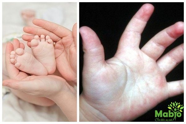 Ra mồ hôi ở chân tay, lưng, gáy là hiện tượng phổ biến với trẻ sơ sinh