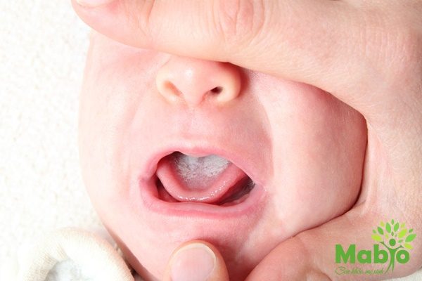 Đẹn ở trẻ sơ sinh: Căn bệnh thường gặp nhưng cần phải đề phòng!