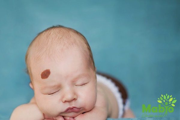 Trẻ sơ sinh có nốt ruồi như thế nào là dấu hiệu của bệnh nguy hiểm?