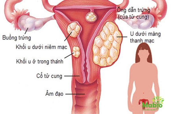 U xơ tử cung rất phổ biến ở phụ nữ