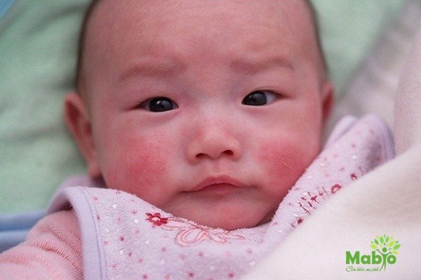 Trẻ sơ sinh bị nổi mẩn đỏ rất phổ biến trong những năm đầu đời