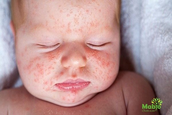 Mụn sữa ở trẻ sơ sinh cũng có biểu hiện ra ngoài là nổi mẩn đỏ