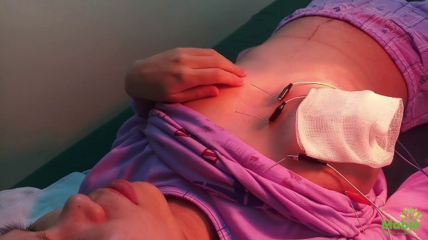 Chữa tắc sữa bằng châm cứu áp dụng với huyệt nào?