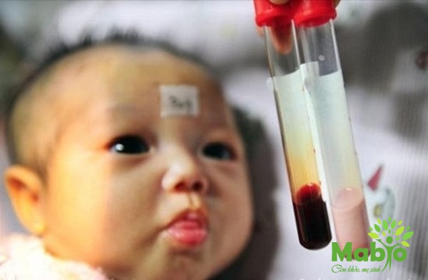 Truyền máu là phương pháp điều trị thiếu máu ở trẻ sinh non được áp dụng rộng rãi